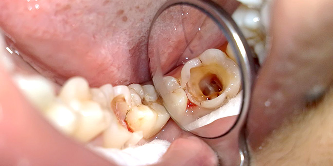 пульпит зубы у детей пример