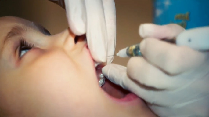 обезболивание детям при лечении зубов